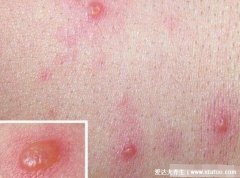 宝宝初期病毒性皮疹图片和症状,水痘/川崎