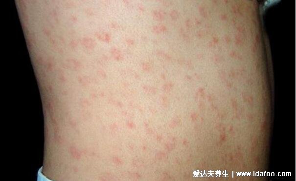 常见男科性疾病图片,梅毒/生殖器疱疹/尖锐湿疣五种症状图