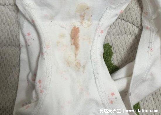 初期宫颈癌的五大征兆，非正常出血/白带异常/外阴瘙痒