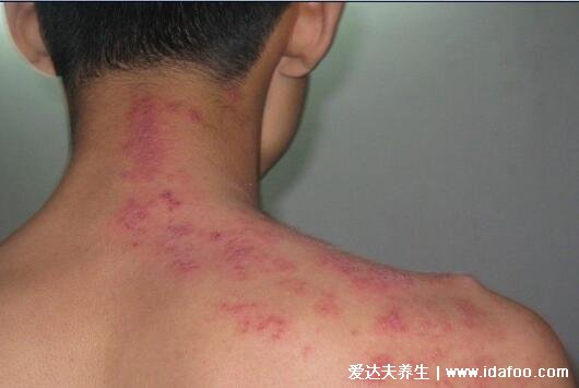 带状疱疹最危险的三个部位,面部/耳朵/外阴肛周引起严重并发症(附图片)