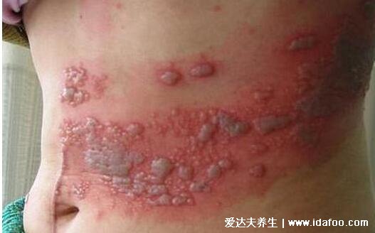 带状疱疹最危险的三个部位,面部/耳朵/外阴肛周引起严重并发症(附图片)