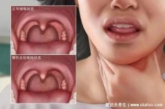 喉咙异物感一个月喉癌可能性大吗,大概率