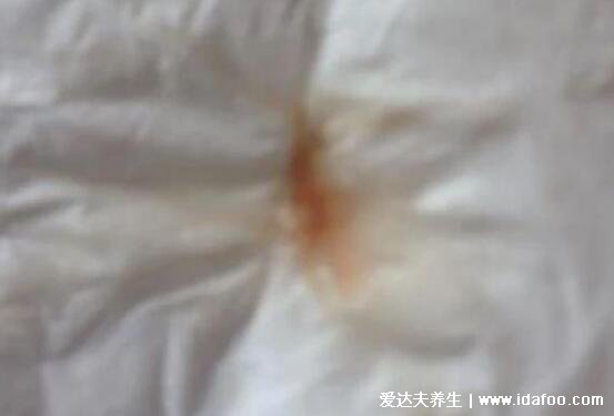 宫颈癌早期症状内裤图片,出现腥臭味/带血分泌物要注意