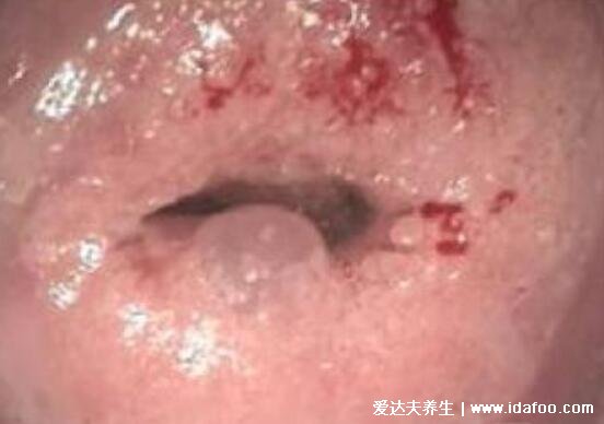 宫颈癌早期症状内裤图片,出现腥臭味/带血分泌物要注意