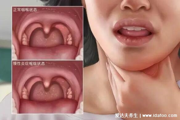 喉咙异物感一个月喉癌可能性大吗,大概率是慢性咽炎/食道炎