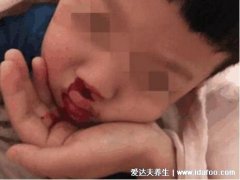 哪种流鼻血需要警惕，小心高血压/白血病