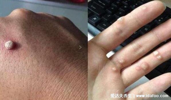 女性感染hpv是什么病毒图片,警惕低危型尖锐湿疣/高危型宫颈癌