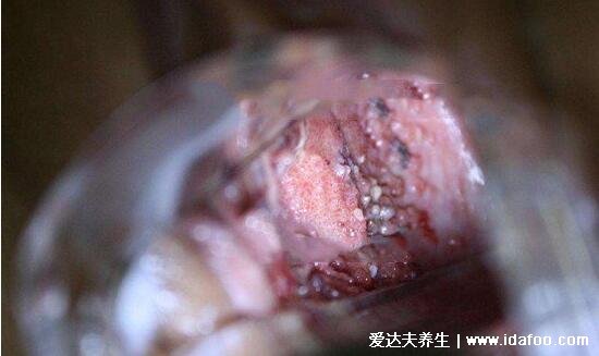 女性感染hpv是什么病毒图片,警惕低危型尖锐湿疣/高危型宫颈癌