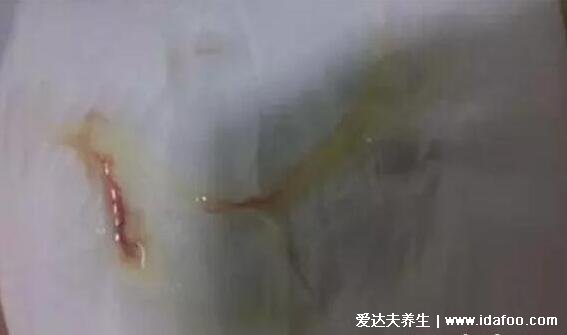 女性感染hpv是什么病毒图片,警惕低危型尖锐湿疣/高危型宫颈癌