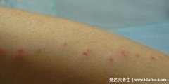 跳蚤咬的红疙瘩长什么样图片,直径不超过