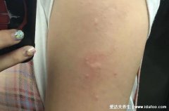 打完第三针新冠疫苗后的不良反应有哪些，