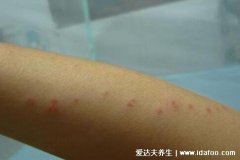 真实跳蚤咬过后的疙瘩照片,呈线状条状有