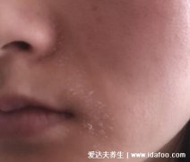 初期脂溢性皮炎图片和症状,头皮上有大块