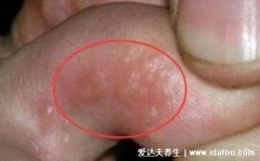 脚气图片水泡型初期症状,有水疱清亮疱液