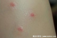 牛皮肤癣的症状图片，丘疹变红斑有磷屑薄