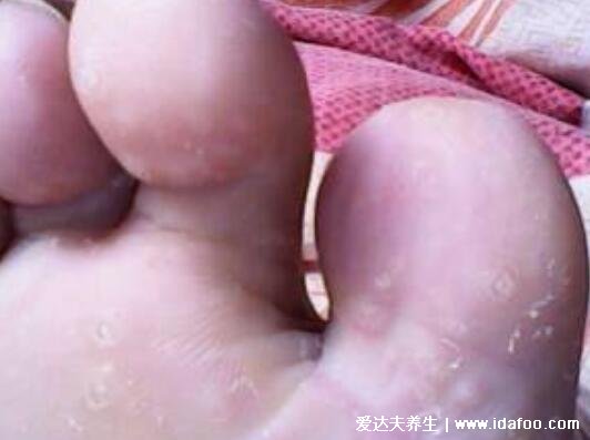 趾疣和跖疣的区别图，只发病位置不同区别不大(鸡眼跖疣区别图)