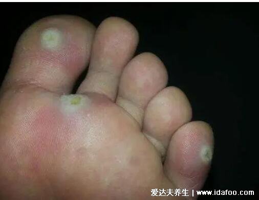 趾疣和跖疣的区别图，只发病位置不同区别不大(鸡眼跖疣区别图)