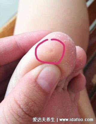 趾疣和跖疣的区别图，只发病位置不同区别不大(鸡眼跖疣区别图)