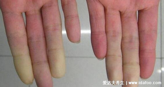 系统性红斑狼疮图片皮肤图片,脸部蝶形红斑日晒后严重