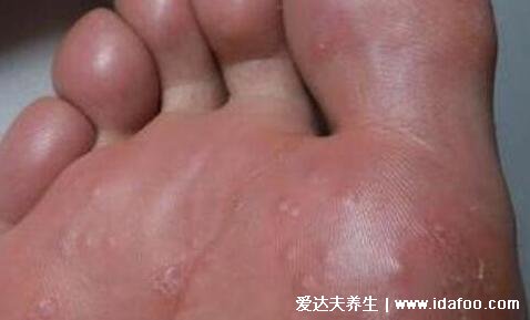 脚气图片水泡型初期症状,有水疱清亮疱液不要挑破(夏季多发)