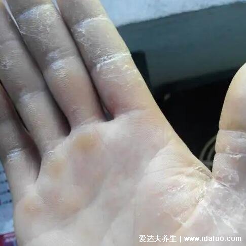 鹅掌风图片症状图片,有白色脱屑脱皮红斑 (三种类型手藓)