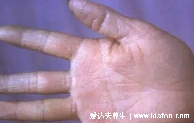 鹅掌风图片症状图片,有白色脱屑脱皮红斑 (三种类型手藓)