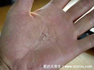 鹅掌风图片症状图片,有白色脱屑脱皮红斑 (三种类型手藓)