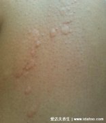初期荨麻疹图片和症状，身上起红疙瘩很痒