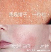 痱子和湿疹的区别图片,外貌症状都不相同
