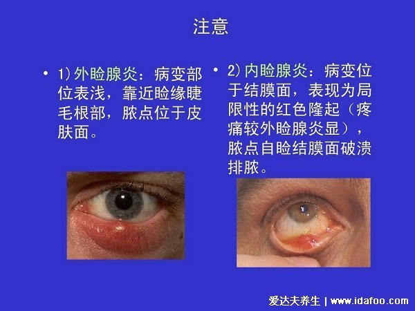 初早期麦粒肿图片及症状,红肿疼痛的脓疱又叫针眼(附消除法)