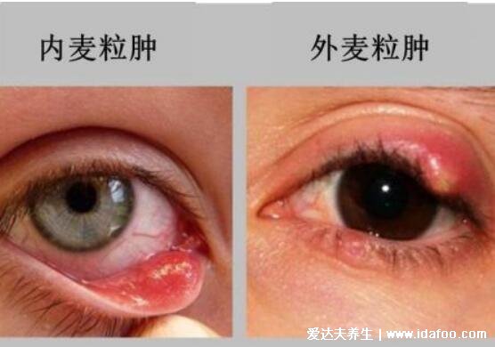 初早期麦粒肿图片及症状,红肿疼痛的脓疱又叫针眼(附消除法)