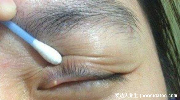 初早期麦粒肿图片及症状,红肿疼痛的脓疱又叫针眼(附消除法)
