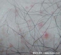 毛囊炎的症状和图片，头部的小脓疱痊愈后
