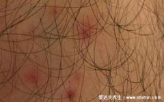 毛囊炎图片初期症状图片，红丘疹可瘙痒(头