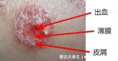 银屑病图片初期症状，红疹有白屑薄膜出血