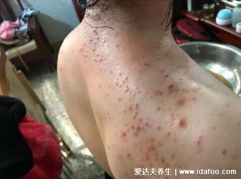 毛囊炎的症状和图片,头部的小脓疱痊愈后留下秃发斑