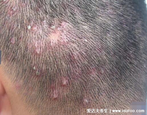 毛囊炎的症状和图片,头部的小脓疱痊愈后留下秃发斑