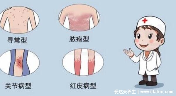 银屑病图片初期症状,红疹有白屑薄膜出血点(不同类型图片)