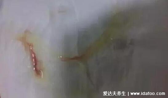 宫颈癌疫苗二价四价九价的区别,价格年龄及不良反应一览表