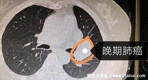 肺部结节最怕三个征兆,警惕磨玻璃样的结节(5%会癌变)