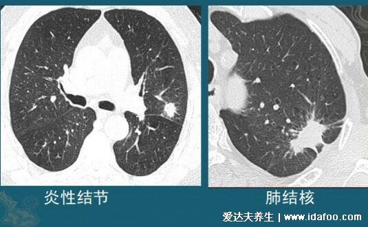 肺部结节最怕三个征兆,警惕磨玻璃样的结节(5%会癌变)