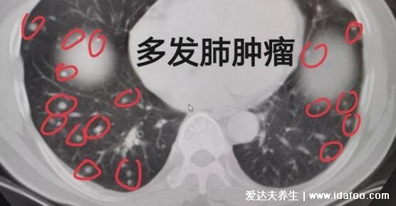 肺部结节最怕三个征兆,警惕磨玻璃样的结节(5%会癌变)