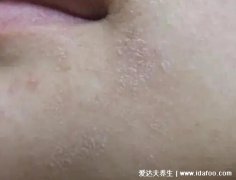 脸上起皮和白色碎屑图片，病理性要注意白