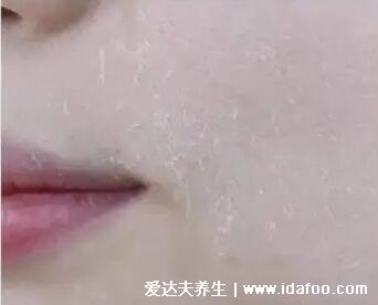 脸上起皮和白色碎屑图片,病理性要注意白色糠疹(5种可能)