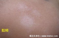 白色糠疹初期图片，白斑表面有灰白色磷屑