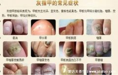 甲沟炎图片和灰指甲的区别图片,甲沟炎指