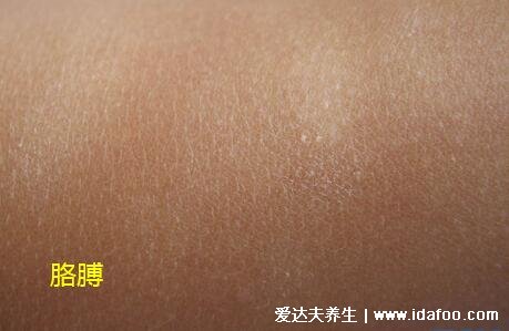 白色糠疹初期图片,白斑表面有灰白色磷屑(和白癜风区分)