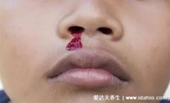 儿童白血病流鼻血特点，不易止住出血量大