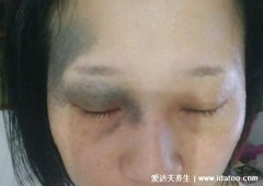 太田痣图片及怎么治最好，长在面部的褐青