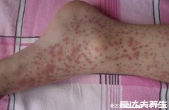 皮肤上有小红点像血点图片及原因，可能是